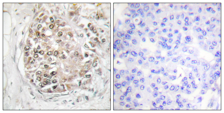 PRKDC / DNA-PKcs Antibody - Immunohistochemistry analysis of paraffin-embedded human breast carcinoma, using DNA-PK (Phospho-Ser2056) Antibody. The picture on the right is blocked with the phospho peptide.