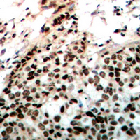 PRKDC / DNA-PKcs Antibody - Immunohistochemical analysis of DNA-PKcs (pT2647) staining in human breast cancer formalin fixed paraffin embedded tissue section. The section was pre-treated using heat mediated antigen retrieval with sodium citrate buffer (pH 6.0). The section was then incubated with the antibody at room temperature and detected using an HRP conjugated compact polymer system. DAB was used as the chromogen. The section was then counterstained with hematoxylin and mounted with DPX.