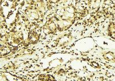 PRKDC / DNA-PKcs Antibody - 1:100 staining human breast carcinoma tissue by IHC-P. The sample was formaldehyde fixed and a heat mediated antigen retrieval step in citrate buffer was performed. The sample was then blocked and incubated with the antibody for 1.5 hours at 22°C. An HRP conjugated goat anti-rabbit antibody was used as the secondary.