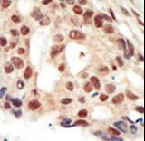PRKG2 / CGKII Antibody - Formalin-fixed and paraffin-embedded human cancer tissue reacted with the primary antibody, which was peroxidase-conjugated to the secondary antibody, followed by AEC staining. This data demonstrates the use of this antibody for immunohistochemistry; clinical relevance has not been evaluated. BC = breast carcinoma; HC = hepatocarcinoma.