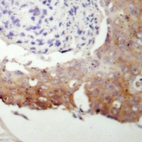 PRKG2 / CGKII Antibody - Immunohistochemical analysis of cGK 2 staining in human prostate cancer formalin fixed paraffin embedded tissue section. The section was pre-treated using heat mediated antigen retrieval with sodium citrate buffer (pH 6.0). The section was then incubated with the antibody at room temperature and detected using an HRP polymer system. DAB was used as the chromogen. The section was then counterstained with hematoxylin and mounted with DPX.