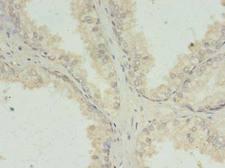 PRKRA / PACT Antibody - Immunohistochemistry of paraffin-embedded human prostate cancer using antibody at dilution of 1:100.