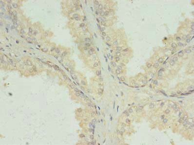 PRKRA / PACT Antibody - Immunohistochemistry of paraffin-embedded human prostate cancer using PRKRA Antibody at dilution of 1:100