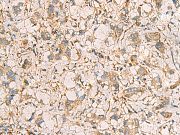 PRKRA / PACT Antibody - Immunohistochemistry of paraffin-embedded Human liver cancer tissue  using PRKRA Polyclonal Antibody at dilution of 1:65(×200)