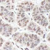 PRKRIR Antibody - Detection of Human PRKRIR by Immunohistochemistry. Sample: FFPE section of human skin basal cell carcinoma. Antibody: Affinity purified rabbit anti-PRKRIR used at a dilution of 1:250. Detection: DAB staining using anti-Rabbit IHC antibody at a dilution of 1:100.