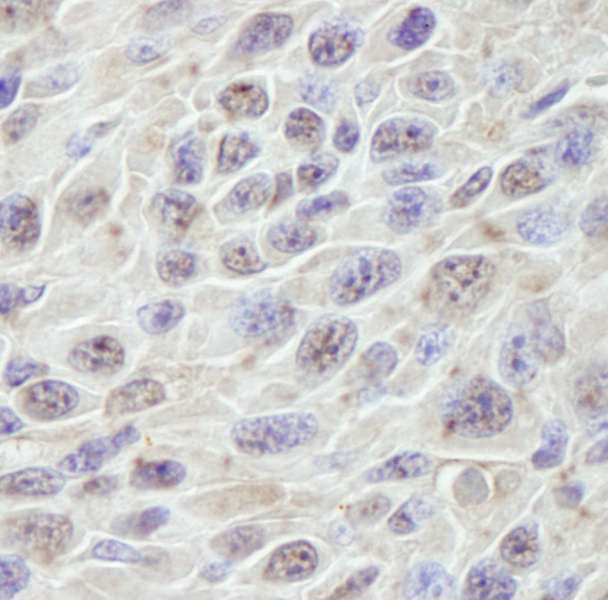 PRKRIR Antibody - Detection of Mouse PRKRIR by Immunohistochemistry. Sample: FFPE section of mouse squamous cell carcinoma. Antibody: Affinity purified rabbit anti-PRKRIR used at a dilution of 1:250. Detection: DAB staining using anti-Rabbit IHC antibody at a dilution of 1:100.