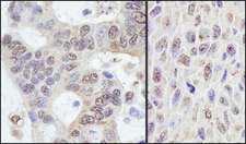 PRKRIR Antibody - Detection of Human and Mouse PRKRIR by Immunohistochemistry. Sample: FFPE sections of human ovarian carcinoma (left) and mouse squamous cell carcinoma (right). Antibody: Affinity purified rabbit anti- PRKRIR used at a dilution of 1:1000 (0.2and 1:200 (1 Detection: DAB.