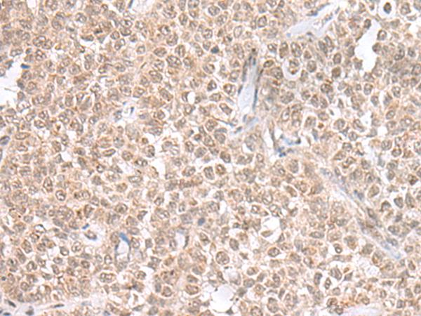 PRKRIR Antibody - Immunohistochemistry of paraffin-embedded Human ovarian cancer tissue  using THAP12 Polyclonal Antibody at dilution of 1:45(×200)