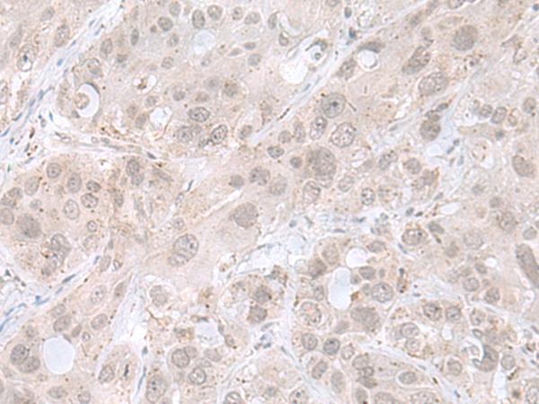 PRKRIR Antibody - Immunohistochemistry of paraffin-embedded Human esophagus cancer tissue  using THAP12 Polyclonal Antibody at dilution of 1:45(×200)