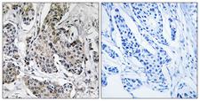 PRKX Antibody - Immunohistochemistry analysis of paraffin-embedded human breast carcinoma tissue, using PRKX Antibody. The picture on the right is blocked with the synthesized peptide.