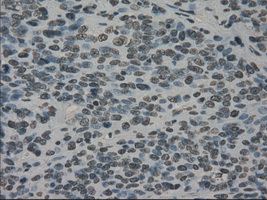 PRKY Antibody - Immunohistochemical staining of paraffin-embedded Carcinoma of bladder tissue using anti-PRKY mouse monoclonal antibody. (Dilution 1:50).