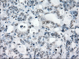 PRKY Antibody - Immunohistochemical staining of paraffin-embedded Adenocarcinoma of colon tissue using anti-PRKY mouse monoclonal antibody. (Dilution 1:50).