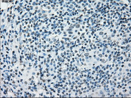 PRKY Antibody - Immunohistochemical staining of paraffin-embedded Carcinoma of thyroid tissue using anti-PRKY mouse monoclonal antibody. (Dilution 1:50).