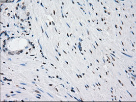 PRKY Antibody - Immunohistochemical staining of paraffin-embedded Carcinoma of prostate tissue using anti-PRKY mouse monoclonal antibody. (Dilution 1:50).