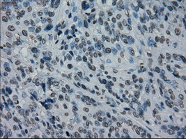 PRKY Antibody - Immunohistochemical staining of paraffin-embedded Carcinoma of bladder tissue using anti-PRKY mouse monoclonal antibody. (Dilution 1:50).