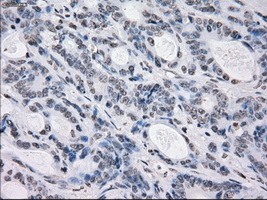 PRKY Antibody - Immunohistochemical staining of paraffin-embedded Adenocarcinoma of colon tissue using anti-PRKY mouse monoclonal antibody. (Dilution 1:50).