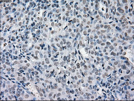 PRKY Antibody - Immunohistochemical staining of paraffin-embedded Adenocarcinoma of endometrium tissue using anti-PRKY mouse monoclonal antibody. (Dilution 1:50).