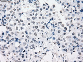 PRKY Antibody - Immunohistochemical staining of paraffin-embedded Adenocarcinoma of breast tissue using anti-PRKY mouse monoclonal antibody. (Dilution 1:50).
