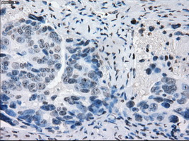 PRKY Antibody - Immunohistochemical staining of paraffin-embedded Adenocarcinoma of ovary tissue using anti-PRKY mouse monoclonal antibody. (Dilution 1:50).