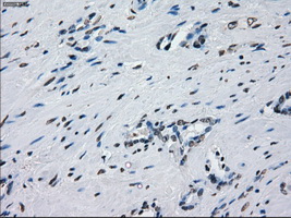 PRKY Antibody - Immunohistochemical staining of paraffin-embedded Carcinoma of prostate tissue using anti-PRKY mouse monoclonal antibody. (Dilution 1:50).