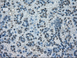 PRKY Antibody - Immunohistochemical staining of paraffin-embedded Carcinoma of kidney tissue using anti-PRKY mouse monoclonal antibody. (Dilution 1:50).