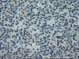 PRKY Antibody - Immunohistochemical staining of paraffin-embedded Carcinoma of thyroid tissue using anti-PRKY mouse monoclonal antibody. (Dilution 1:50).
