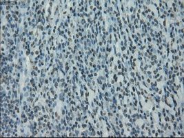 PRKY Antibody - Immunohistochemical staining of paraffin-embedded lymphoma tissue using anti-PRKY mouse monoclonal antibody. (Dilution 1:50).