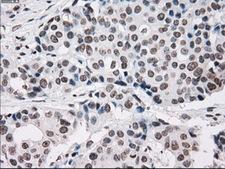 PRKY Antibody - Immunohistochemical staining of paraffin-embedded Adenocarcinoma of breast tissue using anti-PRKY mouse monoclonal antibody. (Dilution 1:50).