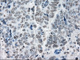 PRKY Antibody - Immunohistochemical staining of paraffin-embedded Adenocarcinoma of ovary tissue using anti-PRKY mouse monoclonal antibody. (Dilution 1:50).