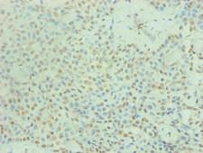 PRL / Prolactin Antibody - Immunohistochemical of paraffin-embedded human breast cancer using PRL Monoclonal Antibody at dilution of 1:200