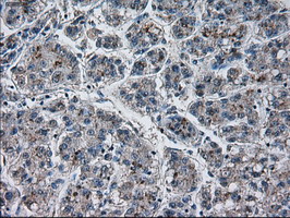 PRL / Prolactin Antibody - IHC of paraffin-embedded Carcinoma of liver tissue using anti-PRL mouse monoclonal antibody. (Dilution 1:50).