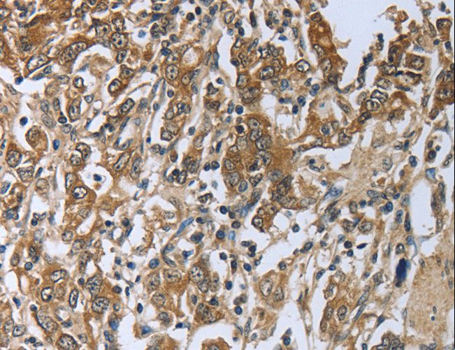 PRL / Prolactin Antibody - Immunohistochemistry of paraffin-embedded Human gastric cancer using PRL Polyclonal Antibody at dilution of 1:50.