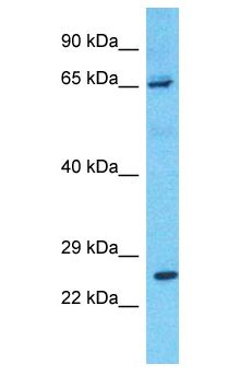 PRLR / Prolactin Receptor Antibody - PRLR / Prolactin Receptor antibody Western Blot of Lymph Node Tumor. Antibody dilution: 1 ug/ml.  This image was taken for the unconjugated form of this product. Other forms have not been tested.