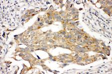 PRLR / Prolactin Receptor Antibody - PRLR / Prolactin Receptor antibody. IHC(P): Human Breast Cancer Tissue.