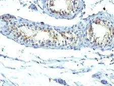 PRLR / Prolactin Receptor Antibody - Formalin-fixed, paraffin-embedded human testicular carcinoma stained with Prolactin Receptor antibody (B6.2 + PRLR742).  This image was taken for the unmodified form of this product. Other forms have not been tested.