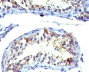 PRLR / Prolactin Receptor Antibody - IHC analysis of Prolactin receptor antibody (clone ERSV8-1) and testicular carcinoma.  This image was taken for the unmodified form of this product. Other forms have not been tested.