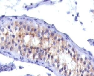 PRLR / Prolactin Receptor Antibody - IHC testing of testicular carcinoma with Prolactin receptor antibody (PRLR742). This image was taken for the unmodified form of this product. Other forms have not been tested.
