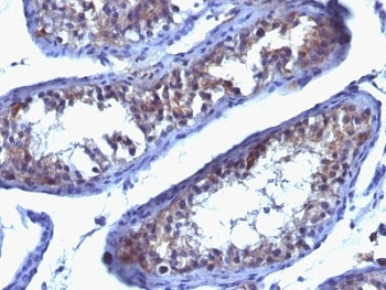 PRLR / Prolactin Receptor Antibody - Formalin-fixed, paraffin-embedded human testicular carcinoma stained with anti-Prolactin Receptor antibody (SPM213).  This image was taken for the unmodified form of this product. Other forms have not been tested.