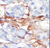 PRLTS / PDGFRL Antibody - Formalin-fixed and paraffin-embedded human cancer tissue reacted with the primary antibody, which was peroxidase-conjugated to the secondary antibody, followed by DAB staining. This data demonstrates the use of this antibody for immunohistochemistry; clinical relevance has not been evaluated. BC = breast carcinoma; HC = hepatocarcinoma.