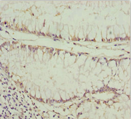 PRLTS / PDGFRL Antibody - Immunohistochemistry of paraffin-embedded human colon cancer at dilution 1:100