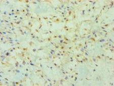 PRMT2 Antibody - Immunohistochemistry of paraffin-embedded human breast cancer using antibody at 1:100 dilution.