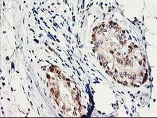 PRMT2 Antibody - IHC of paraffin-embedded Adenocarcinoma of Human breast tissue using anti-PRMT2 mouse monoclonal antibody.