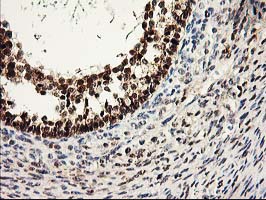 PRMT2 Antibody - IHC of paraffin-embedded Adenocarcinoma of Human ovary tissue using anti-PRMT2 mouse monoclonal antibody.