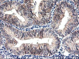 PRMT2 Antibody - IHC of paraffin-embedded Adenocarcinoma of Human endometrium tissue using anti-PRMT2 mouse monoclonal antibody.