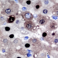 PRMT2 Antibody - Immunohistochemical analysis of PRMT2 staining in human liver cancer formalin fixed paraffin embedded tissue section. The section was pre-treated using heat mediated antigen retrieval with sodium citrate buffer (pH 6.0). The section was then incubated with the antibody at room temperature and detected using an HRP conjugated compact polymer system. DAB was used as the chromogen. The section was then counterstained with hematoxylin and mounted with DPX.