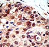 PRMT3 Antibody - Formalin-fixed and paraffin-embedded human cancer tissue reacted with the primary antibody, which was peroxidase-conjugated to the secondary antibody, followed by DAB staining. This data demonstrates the use of this antibody for immunohistochemistry; clinical relevance has not been evaluated. BC = breast carcinoma; HC = hepatocarcinoma.