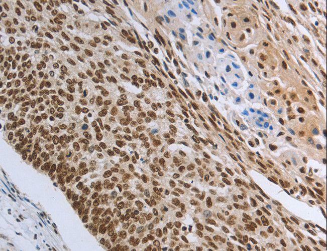 PRMT3 Antibody - Immunohistochemistry of paraffin-embedded Human colon cancer using PRMT3 Polyclonal Antibody at dilution of 1:30.