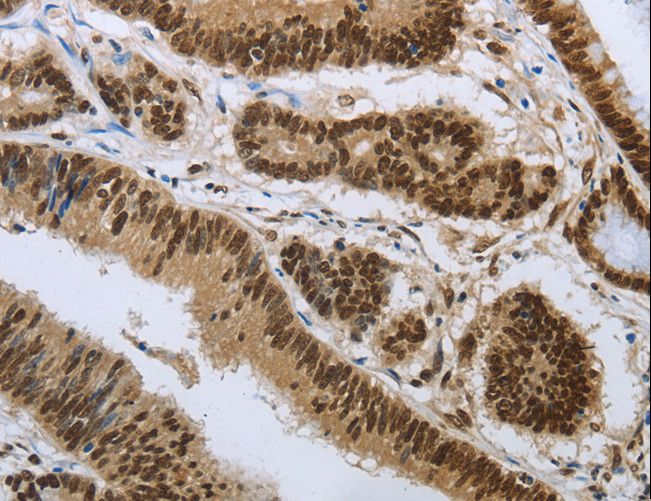 PRMT3 Antibody - Immunohistochemistry of paraffin-embedded Human colon cancer using PRMT3 Polyclonal Antibody at dilution of 1:30.
