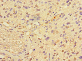 PRMT3 Antibody - Immunohistochemistry of paraffin-embedded human glioma cancer at dilution 1:100