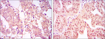 PRMT4 / CARM1 Antibody - IHC of paraffin-embedded breast cancer tissues (left) and ovarian cancer tissues (right) using CARM1 mouse monoclonal antibody with DAB staining.